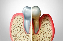 Comparison of healthy and unhealthy gums