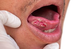 Man with oral cancer on his tongue
