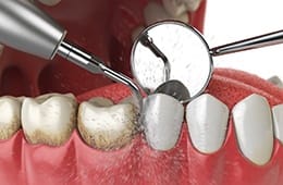 computer illustration of a dentist cleaning a patient’s teeth