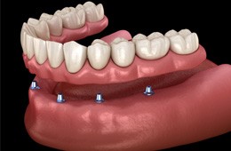 an example of implant dentures in Campbell