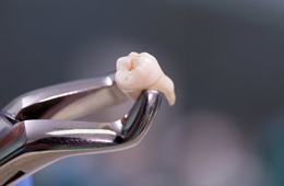 A pair of dental forceps holding an extracted tooth.