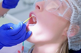 Dentist applying fluoride varnish to patient's teeth in Campbell