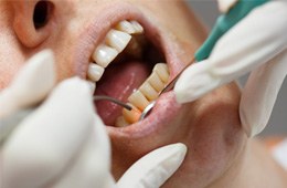 Dental laser treating gum disease