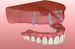  Dentures getting attached to four dental implants