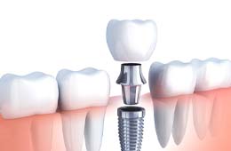 dental implant in Campbell, CA