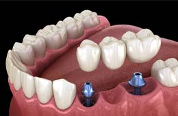 two dental implants holding a bridge