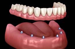 six dental implants holding a full denture