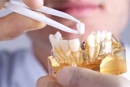 dentist putting a crown on a dental implant