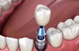 single dental implant with a crown