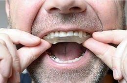 Man placing a clear nightguard for teeth grinding