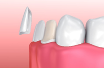 Model showing temporary veneers